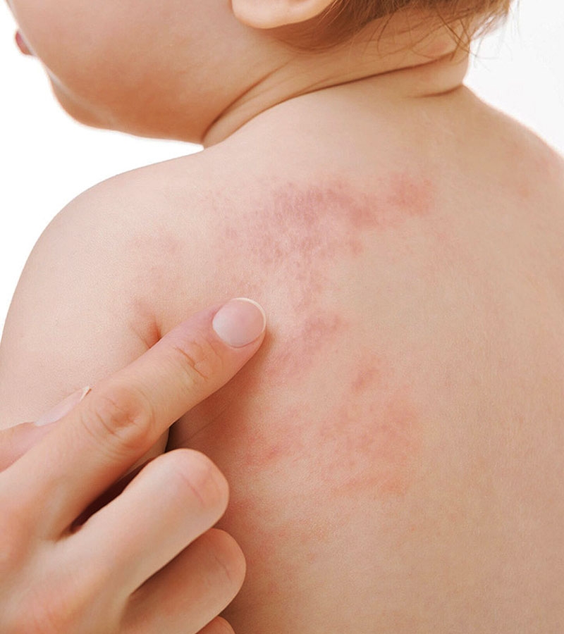 Dermatología Pediátrica