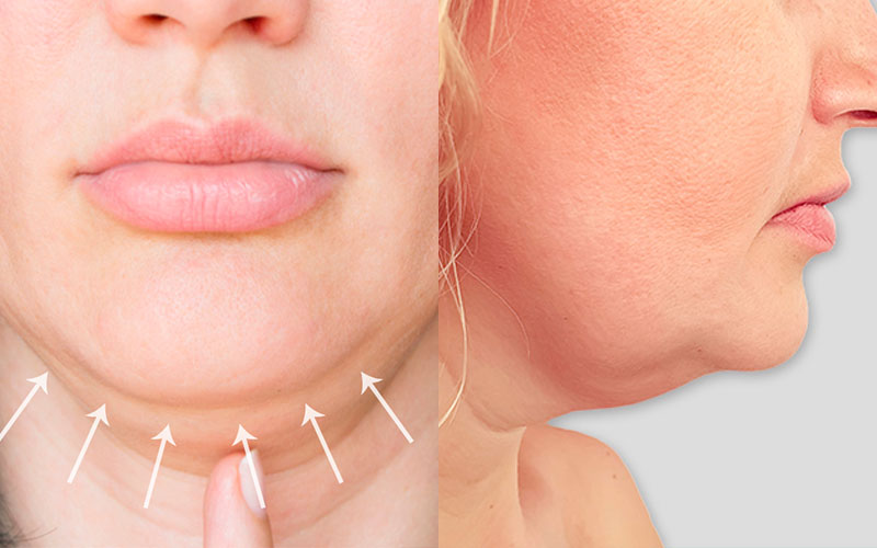 Lipopapada sin cirugía en Lima.