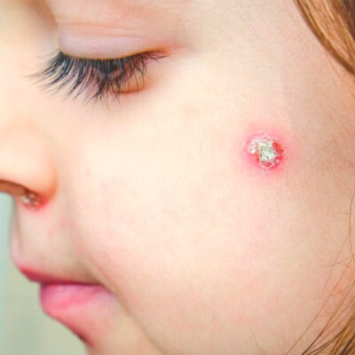 Abscesos-en-la-piel