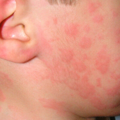 Alergias-pediatria
