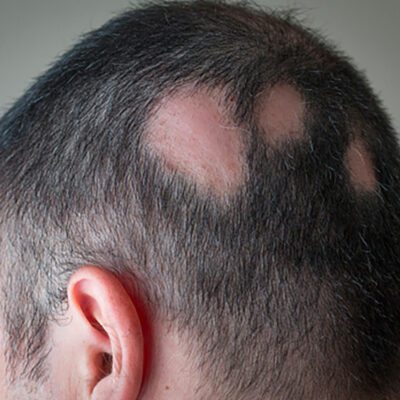 Alopecia