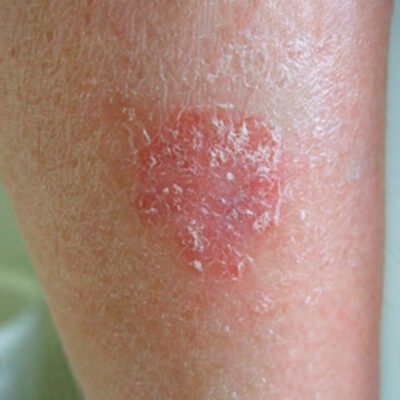 Celulitis-Infección-Hongos