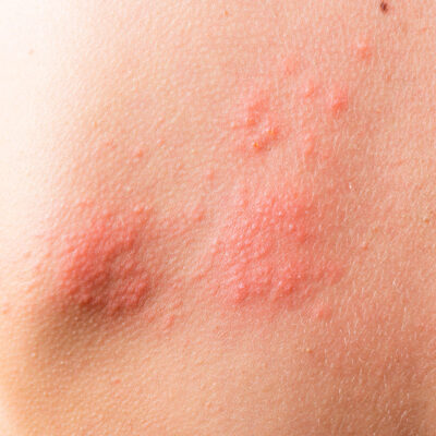 Dermatitis-Atópica