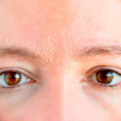Dermatitis-Seborreica