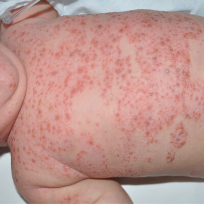 Eccema-pediatria
