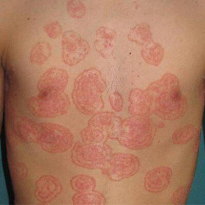 Enfermedades-Infecciosas