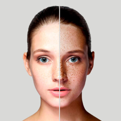 Laser-Pecas