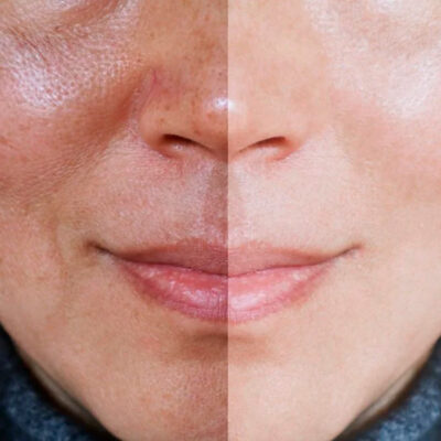 Melasma