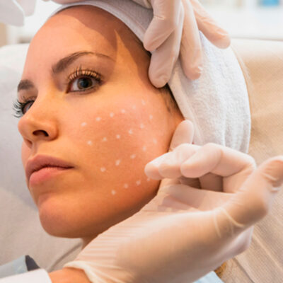 Mesoterapia-Facial