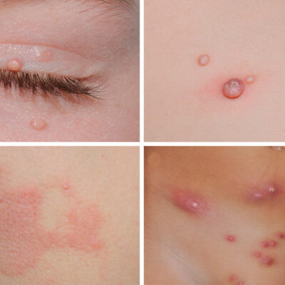 Moluscos-Contagiosos