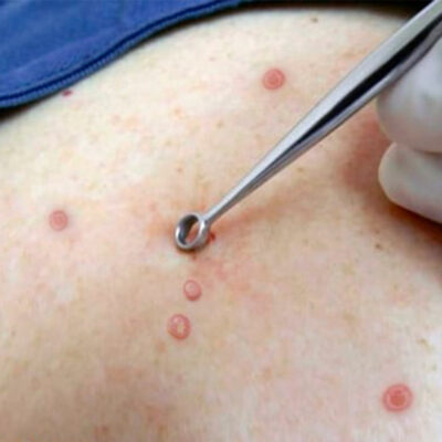 Moluscos-contagiosos