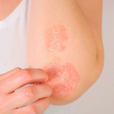Psoriasis