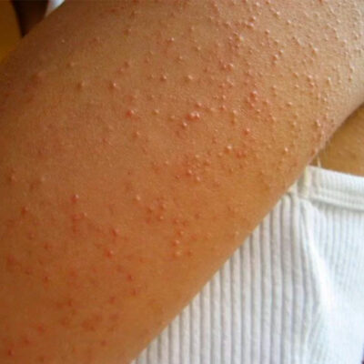 Queratosis-Pilaris