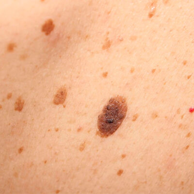 Queratosis-Seborreica-Peelings-Químicos-dermatologia