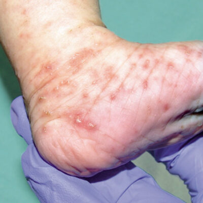 Sarna-pediatria