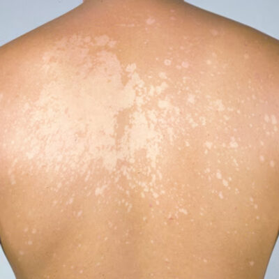 Tinea-Versicolor