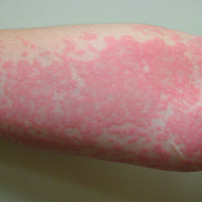 Urticaria