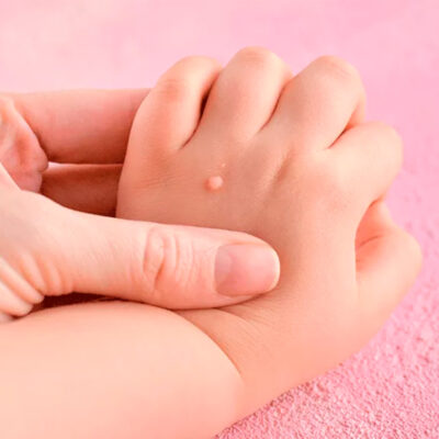 Verrugas-pediatria