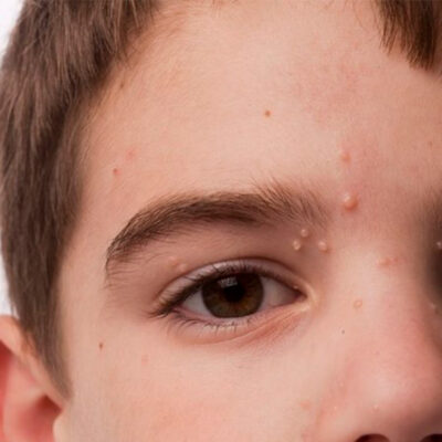molusco-contagioso-pediatria