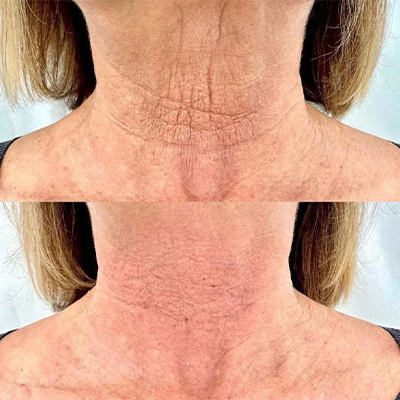 rejuvenecimiento-cuello-y-escote